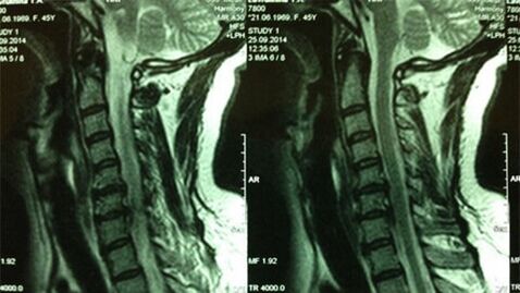 MRI بخش دهانه رحم