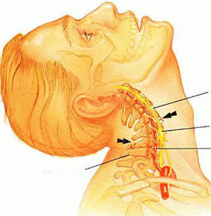 استئوکندروز ستون فقرات گردنی