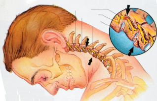 چه اتفاقی با استئوکندروز گردنی رخ می دهد