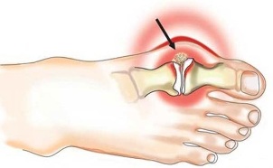 التهاب مفصل بین انگشت شست و پا در آرتروز