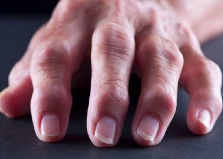 آرتریت روماتوئید به عنوان علت درد در مفاصل انگشتان دست