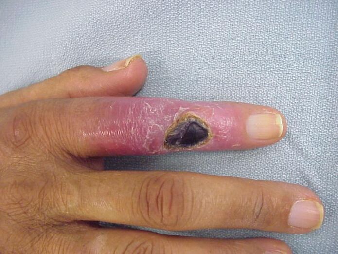 استئومیلیت به عنوان علت درد در مفاصل انگشتان دست
