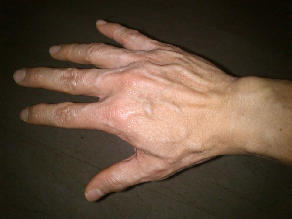 تغییر شکل استخوان ها و درد در مفاصل انگشتان