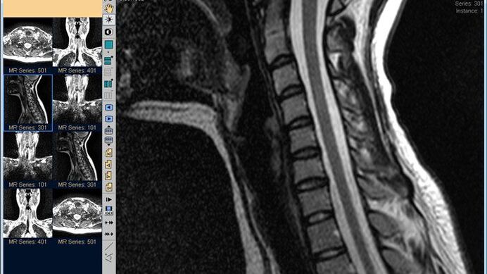 MRI ستون فقرات گردنی بهترین روش برای تشخیص گردن درد است